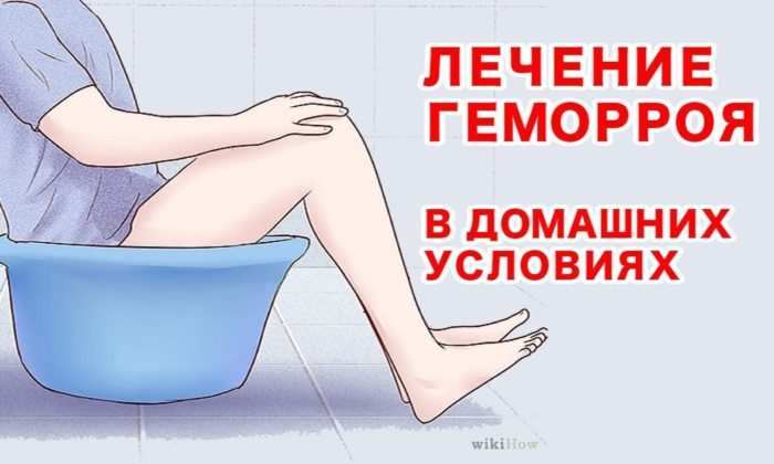 Лечение геморроя в домашних условиях