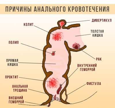 У меня геморрой кровоточит как лечить в домашних условиях thumbnail