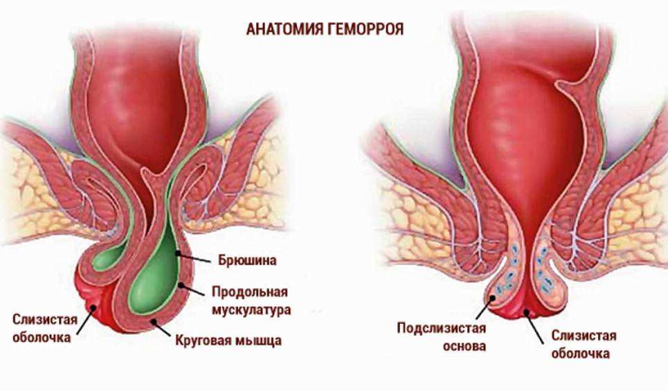 Геморрой состоит из этих нескольких частей