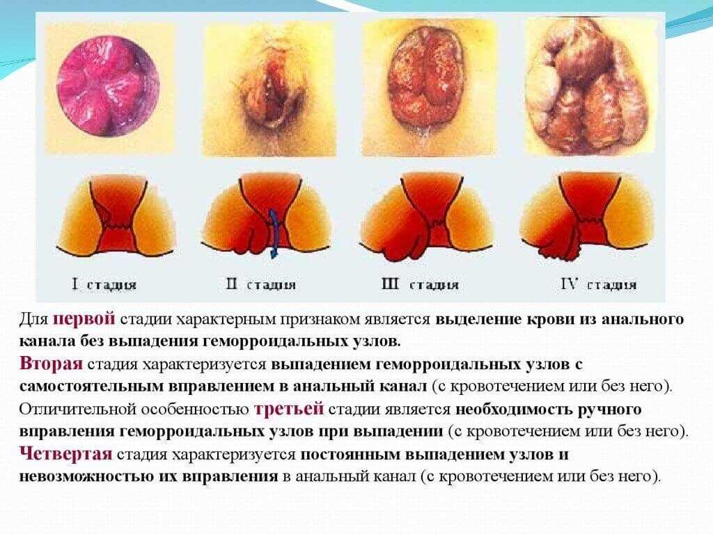 Стадии геморроя с описанием