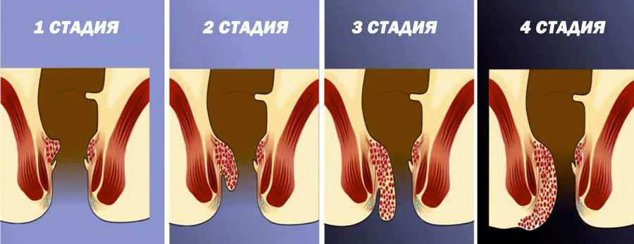 При отсутствии лечения геморрой прогрессирует